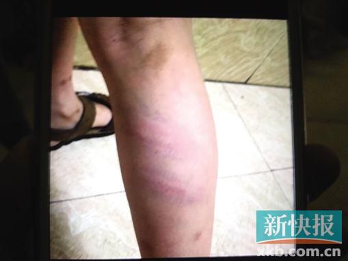 小宇腿部有明顯瘀痕。 翻拍自家屬手機