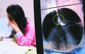 假牙上的鋼絲刺破食管，而薄薄的食道壁緊貼主動脈血管，極易造成血管破裂