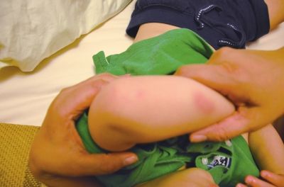 孩子身上有多處明顯傷痕。京華時報讀者供圖