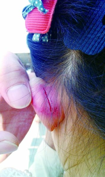 　　女童的耳朵被老師揪裂。圖片由女童家人提供