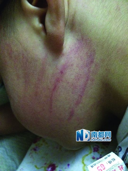 小逸臉上淤痕清晰可見(jiàn)。