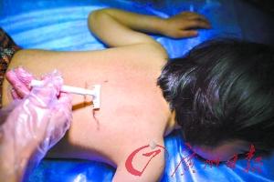 9歲女童得怪病 因服用廉價激素藥物致全身長毛