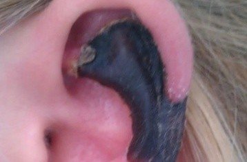 荷蘭女子旅游途中被蜘蛛咬，耳軟骨溶解變黑。