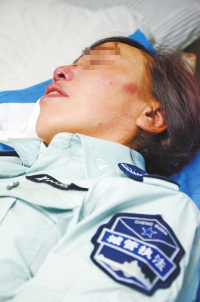 女城管面頰及鼻梁受傷 女城管面頰及鼻梁受傷