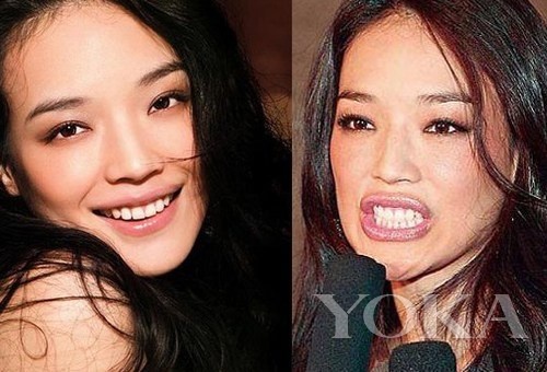 牙齒凸出，口輪肌過于松弛