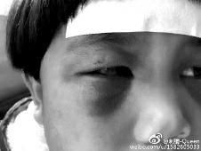 6月2日，網(wǎng)曝渭南市臨渭區(qū)一不滿5歲的女童遭奶奶毆打，眼圈青腫，引起網(wǎng)友關(guān)注，但孩子父母和爺爺均稱是摔倒導致。相關(guān)部門介入調(diào)查發(fā)現(xiàn)確為奶奶毆打所致，鑒于其身體原因已進行批評教育。