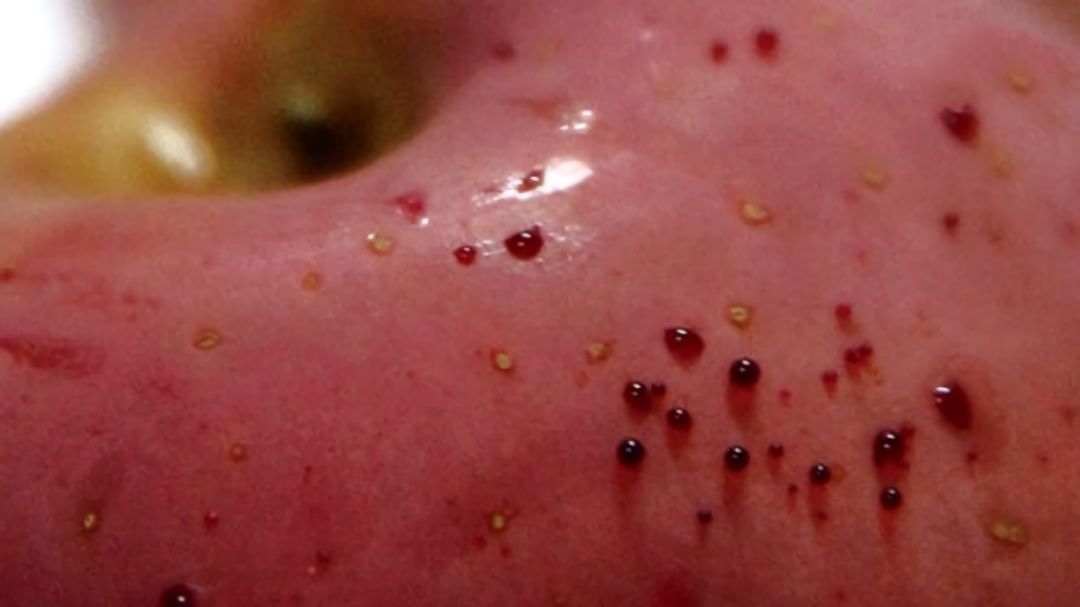 嚇懵！女子用熱水泡蘋果結(jié)果冒出血珠 咋回事？