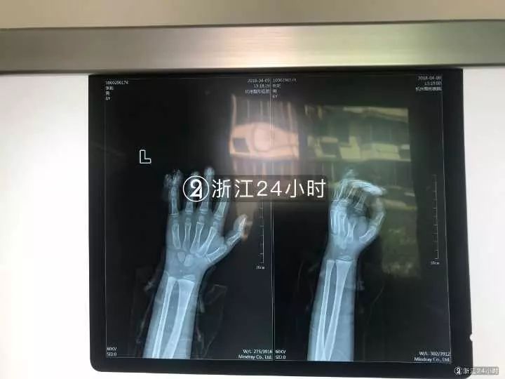 嚇哭！6歲男孩被夾斷手指 罪魁禍首竟是校服