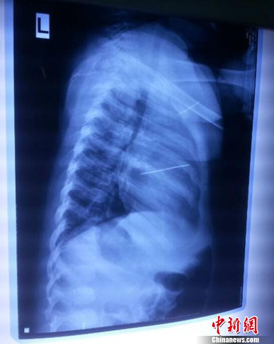 河南心臟被扎針女嬰術(shù)后尚未脫險家人渴求真相