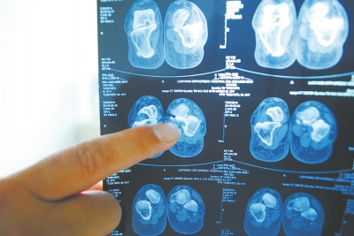 X光片顯示,確實有一根殘留的螺絲釘。