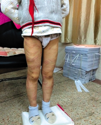 4月3日晚，微博網(wǎng)友“@朝廷半日閑”發(fā)圖文微博展示男童被虐待的慘狀。 微博截圖