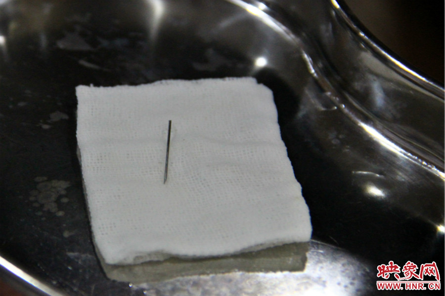 上午11點30分許，小龍腦中鋼針已經(jīng)成功取出。