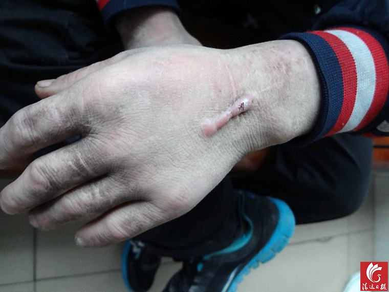 被發(fā)現(xiàn)男子手上的傷疤。