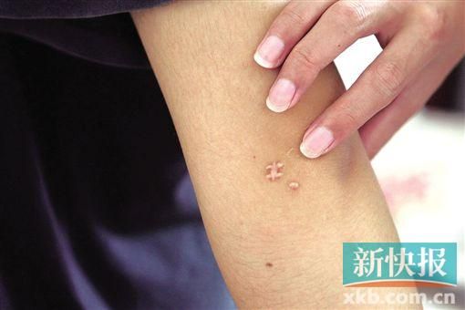 取出針后李星兒手臂留下了傷口。新快報(bào)記者 張國(guó)鋒/攝