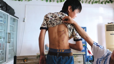 　昨日，奶西村，被打的小剛后背上條條瘀痕依然明顯。