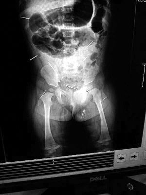 目前體內(nèi)的12根鋼針多分布在孩子的臀部，一根在腹部，其余3根在胸腔附近，其中一根很接近心臟