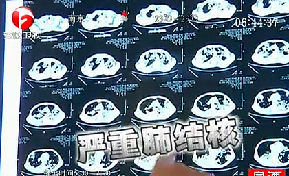 男子泡網(wǎng)吧七年導致嚴重肺結核